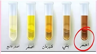 لون البول يكشف عن حالتك الصحية تعرف إذا كنت خاليا من الأمــراض أو تحتاج الذهاب لطبيب