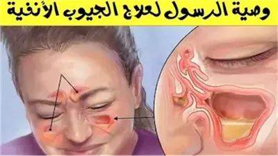 وصية الرسول صلى الله عليه وسلم لعلاج التهابات الجيوب الأنفية!