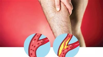 انتبه لساقيك- 6 أعراض لانسداد الشرايين تظهر عليهما