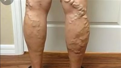 لا تشترِ بعد اليوم أدوية علاج الدوالي بهذه الوصفة البسيطة ستشفى منها في ثلاثة أيام فقط