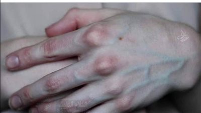 لماذا تظهر عروق بعض الناس من الجلد وتختفي عند آخرين