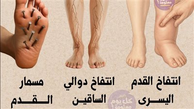 أسباب انتفاخ القدم اليسرى ودواعي القلق  وعلاقة الدوالي والسمنة ومسمار القدم وسقوط الشعر بالصحة العامة