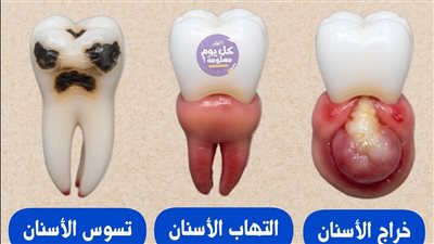 مشاكل الأسنان الشائعة الأسباب وطرق الوقاية دليل شامل لصحة الفم والأسنان