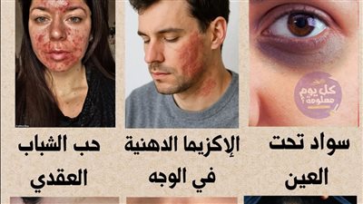 اسباب ظهور الهالات السوداء والإكزيما الدهنية وحب الشباب وحبوب الظهر وتشقق الشفاه واحمرار الوجه