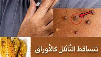 هندسة إزالة الثآليل: الحقيقة العلمية لعلاج الزوائد الجلدية بقشور الموز (2026)